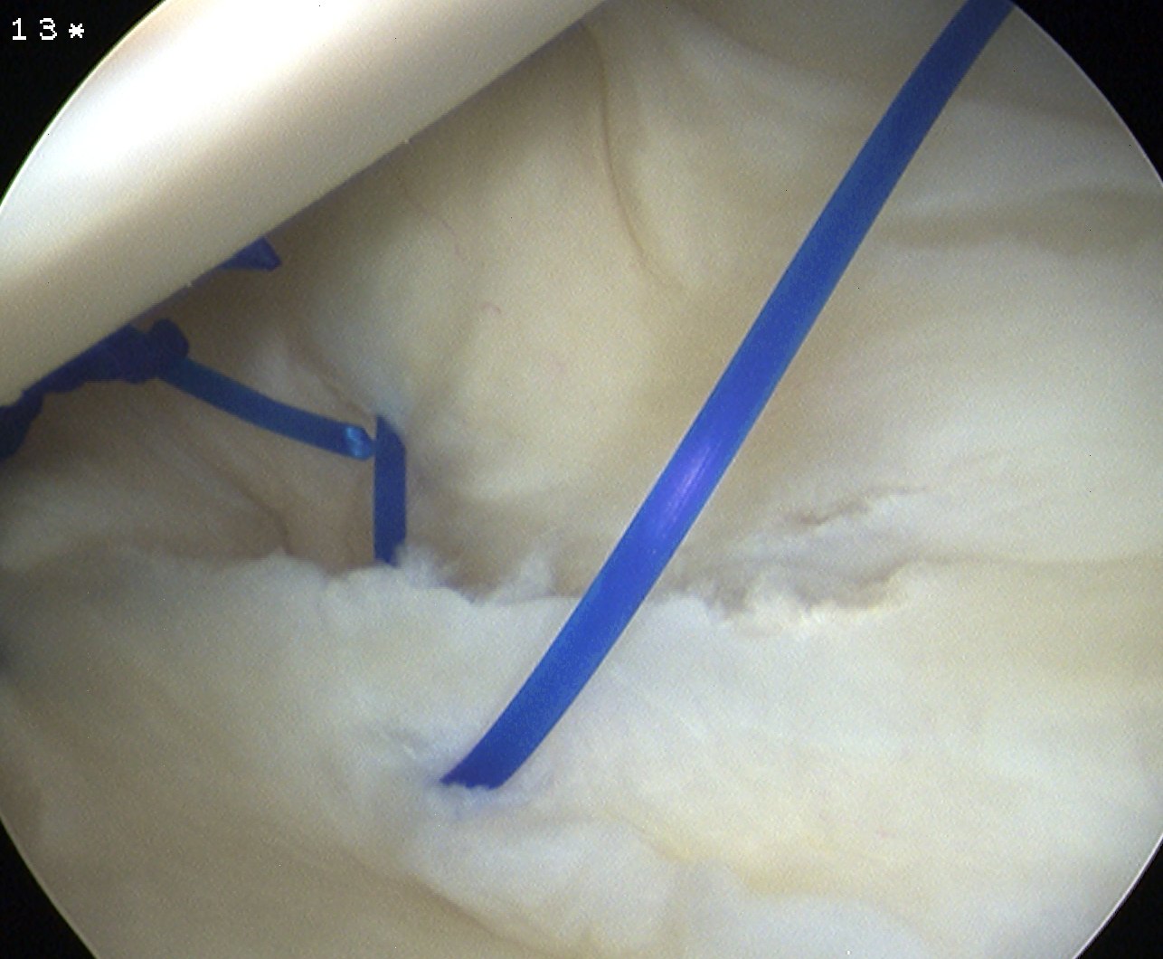 MDI 2 bites anterior capsule